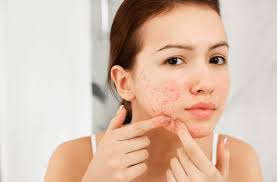 Pele com Acne na Vida Adulta? Descubra as Causas Ocultas e Como Resolver